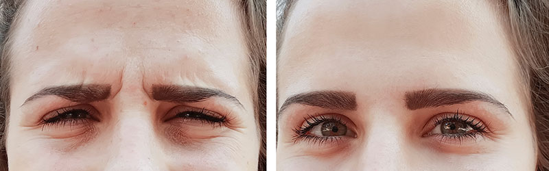 Anti-Ageing Treatment