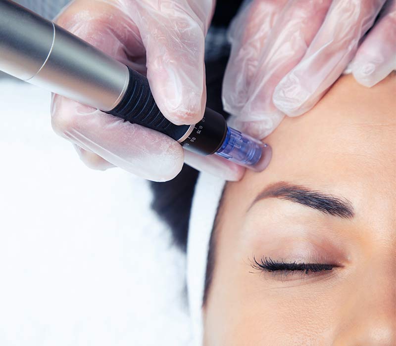 EC x Ccoco Microneedling Treatment