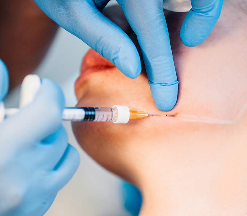 Dermal Fillers
