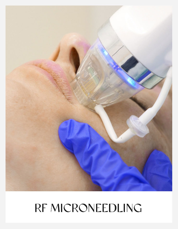 RF & Laser Treatment